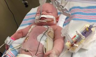 新生儿窒息 新生儿窒息